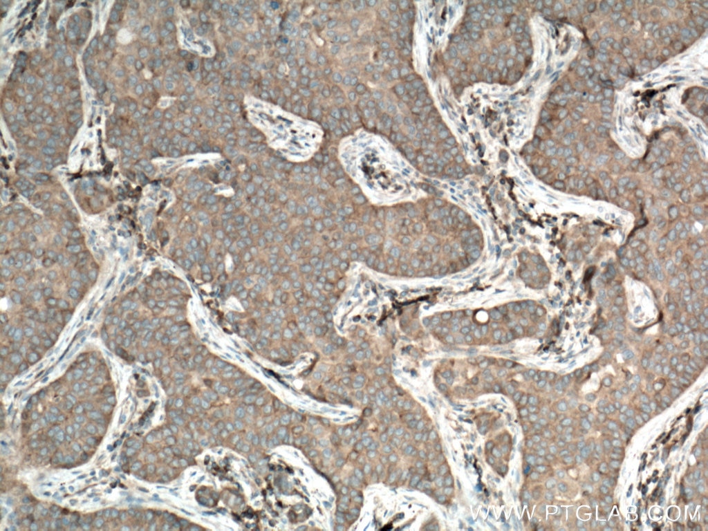 Immunohistochemistry (IHC) staining of human breast cancer tissue using YES1 Polyclonal antibody (13977-1-AP)