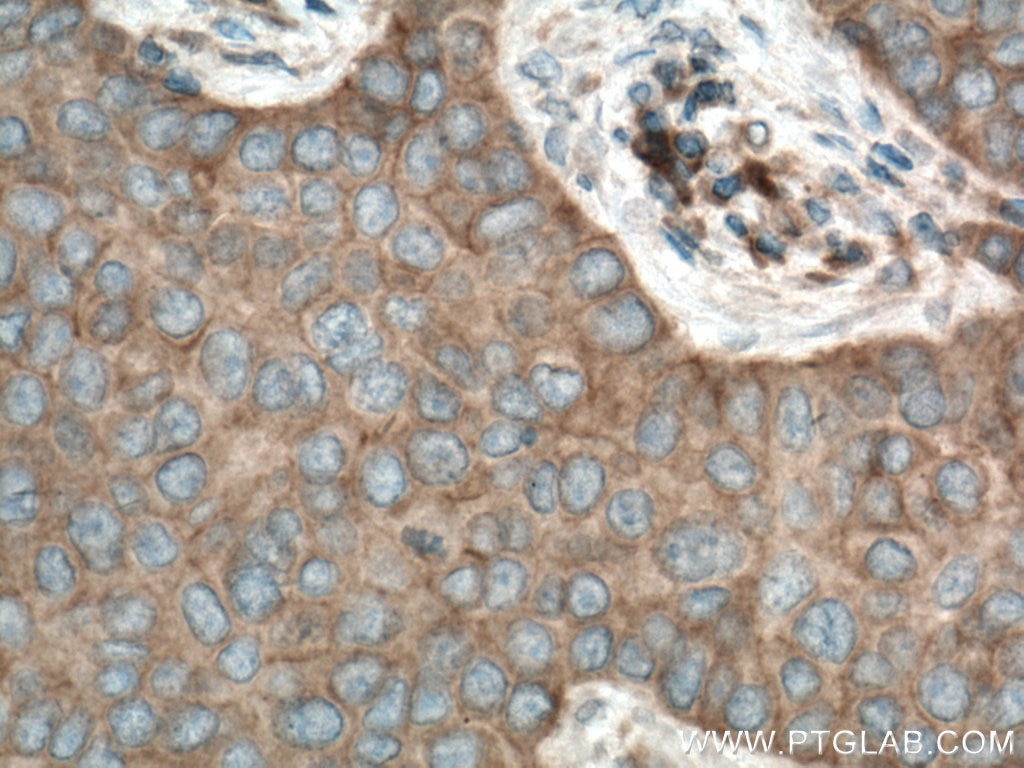 Immunohistochemistry (IHC) staining of human breast cancer tissue using YES1 Polyclonal antibody (13977-1-AP)
