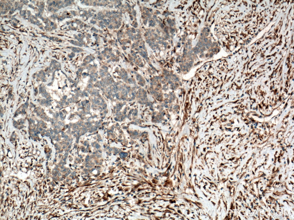 IHC staining of human colon cancer using 20243-1-AP