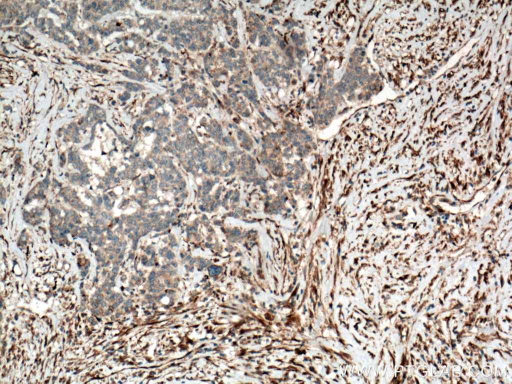 Immunohistochemistry (IHC) staining of human colon cancer tissue using YES1-Specific Polyclonal antibody (20243-1-AP)