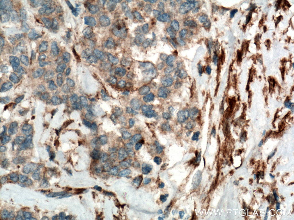 Immunohistochemistry (IHC) staining of human colon cancer tissue using YES1-Specific Polyclonal antibody (20243-1-AP)