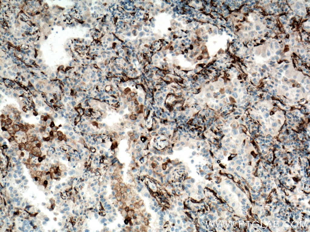 Immunohistochemistry (IHC) staining of human lung cancer tissue using YES1-Specific Polyclonal antibody (20243-1-AP)