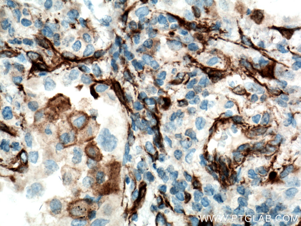 Immunohistochemistry (IHC) staining of human lung cancer tissue using YES1-Specific Polyclonal antibody (20243-1-AP)