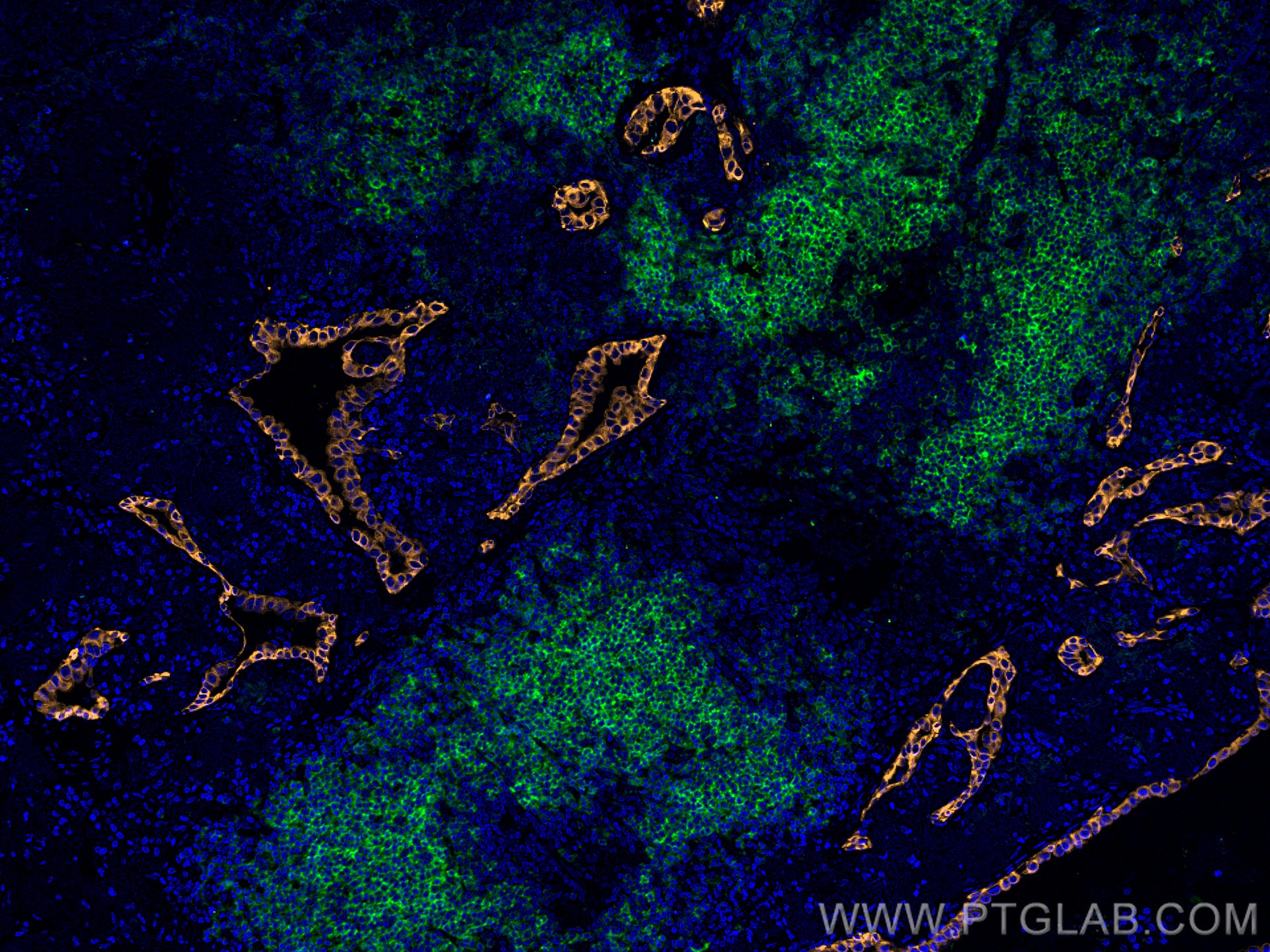 Immunofluorescence (IF) / fluorescent staining of human lung cancer tissue using CoraLite® Plus 488-conjugated CD20 Monoclonal anti (CL488-60271)