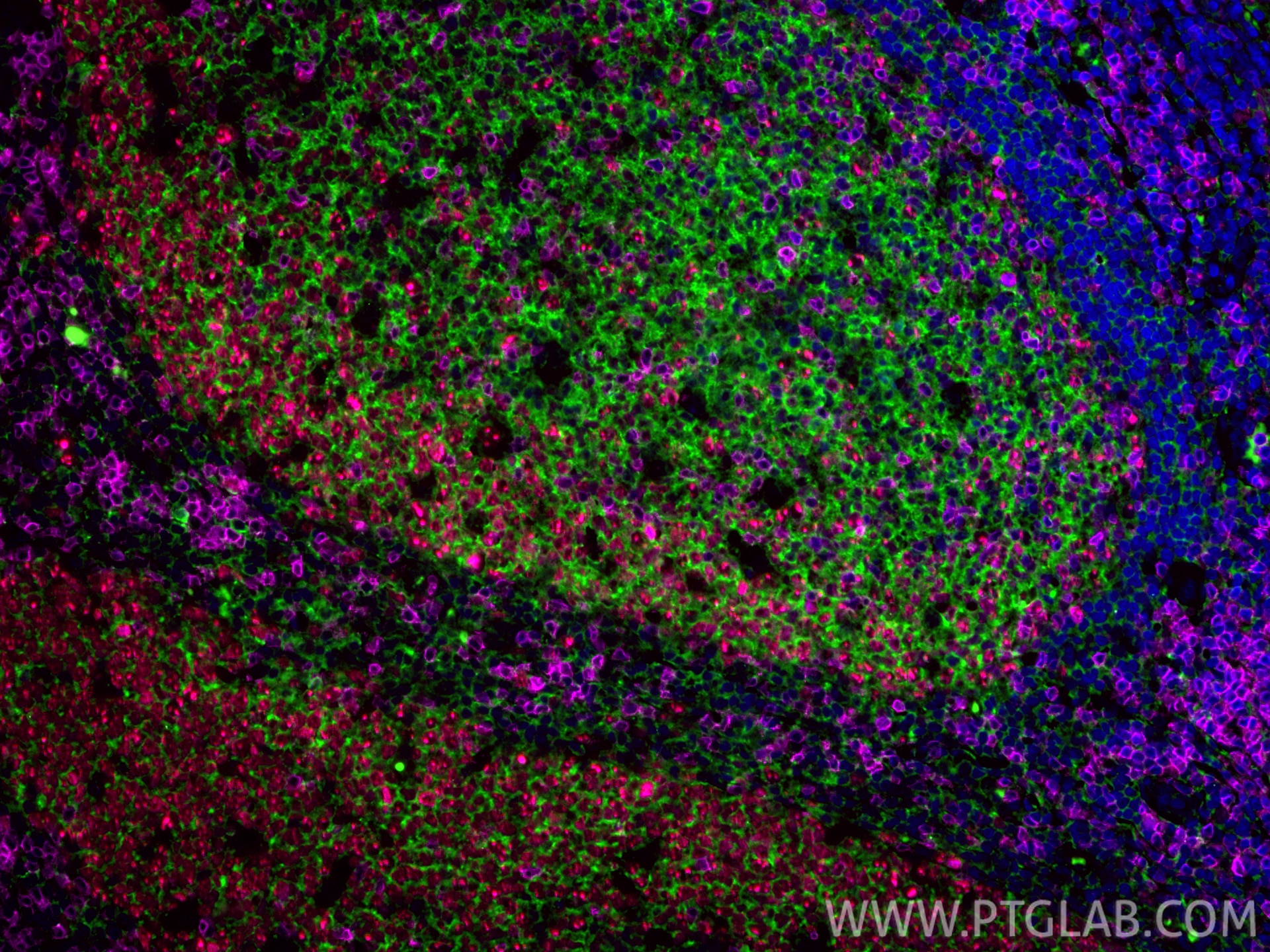 Immunofluorescent analysis of (4% PFA) fixed paraffin-embedded human tonsillitis tissue using CoraLite® Plus 488 CD20 antibody (CL488-60271, Clone: 4A7G3 ) at dilution of 1:200, CoraLite®594 Ki-67 antibody (CL594-84192-4, Clone: 241499E7, red), CoraLite® Plus 647 CD3 antibody (CL647-17617, Magenta). Heat mediated antigen retrieval with Tris-EDTA buffer (pH 9.0). Immunofluorescence (IF) / fluorescent staining of human tonsillitis tissue using CoraLite® Plus 488-conjugated CD20 Monoclonal anti (CL488-60271)