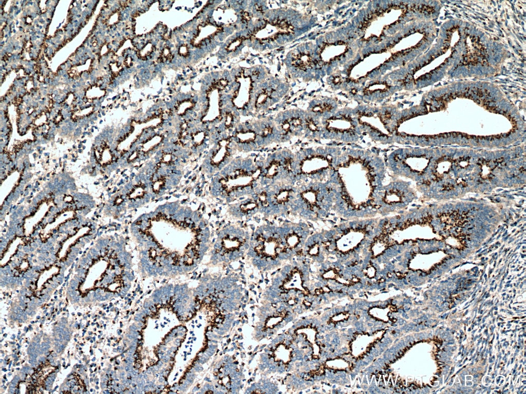 Immunohistochemistry (IHC) staining of human endometrial cancer tissue using YIPF4 Polyclonal antibody (15473-1-AP)