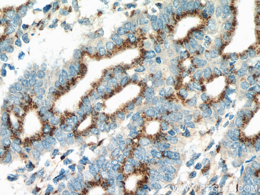 Immunohistochemistry (IHC) staining of human endometrial cancer tissue using YIPF4 Polyclonal antibody (15473-1-AP)