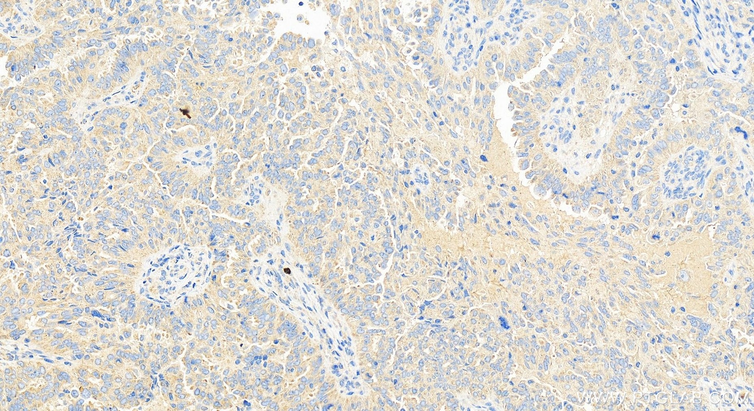 Immunohistochemistry (IHC) staining of human ovary cancer tissue using YIPF5 Polyclonal antibody (12931-1-AP)