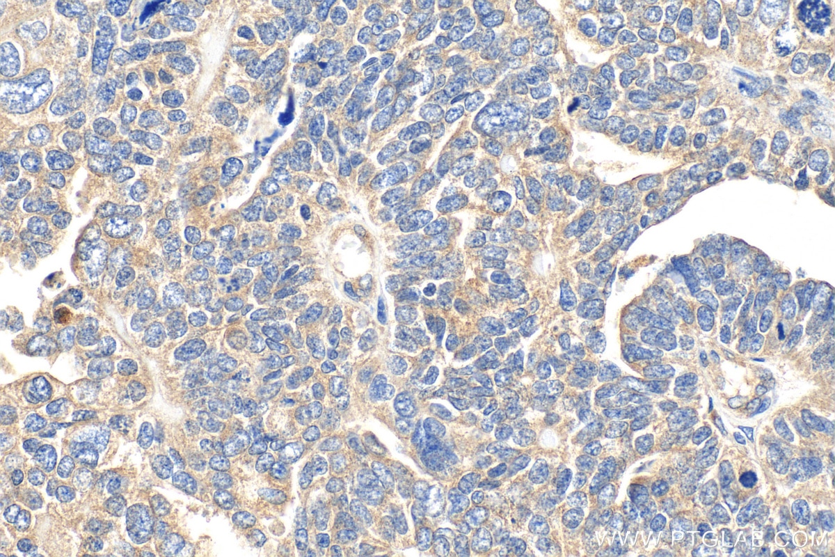 Immunohistochemistry (IHC) staining of human ovary tumor tissue using YKT6 Polyclonal antibody (33685-1-AP)