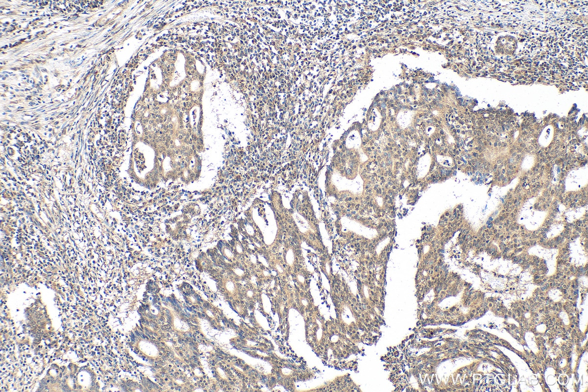 IHC staining of human endometrial cancer using 15403-1-AP