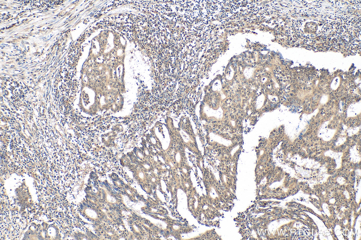 Immunohistochemistry (IHC) staining of human endometrial cancer tissue using YPEL3 Polyclonal antibody (15403-1-AP)