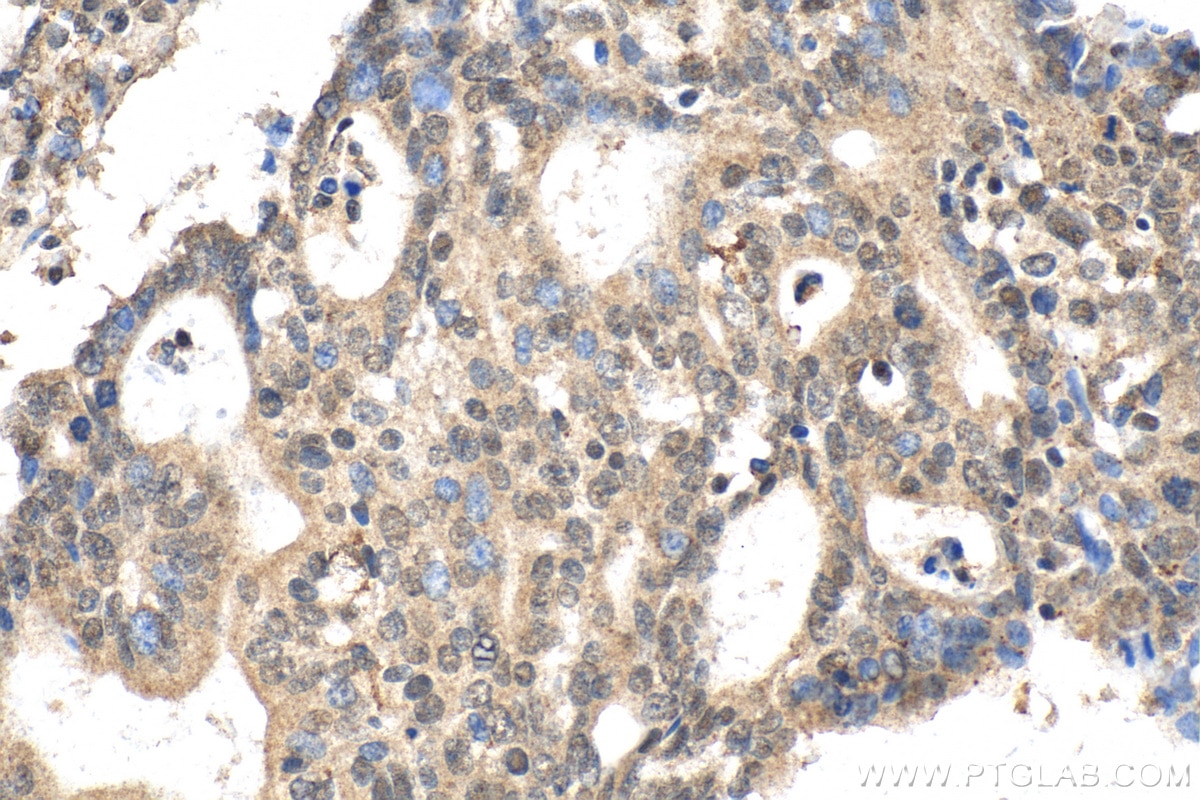 Immunohistochemistry (IHC) staining of human endometrial cancer tissue using YPEL3 Polyclonal antibody (15403-1-AP)