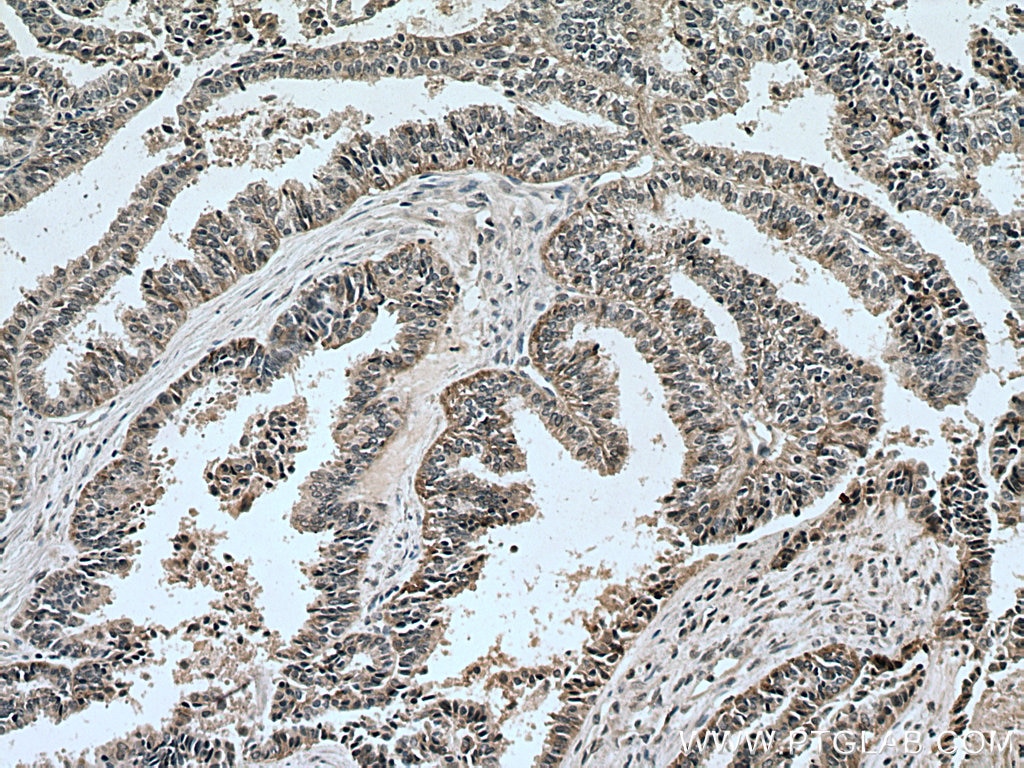 Immunohistochemistry (IHC) staining of human ovary tumor tissue using YTHDC1 Polyclonal antibody (14392-1-AP)