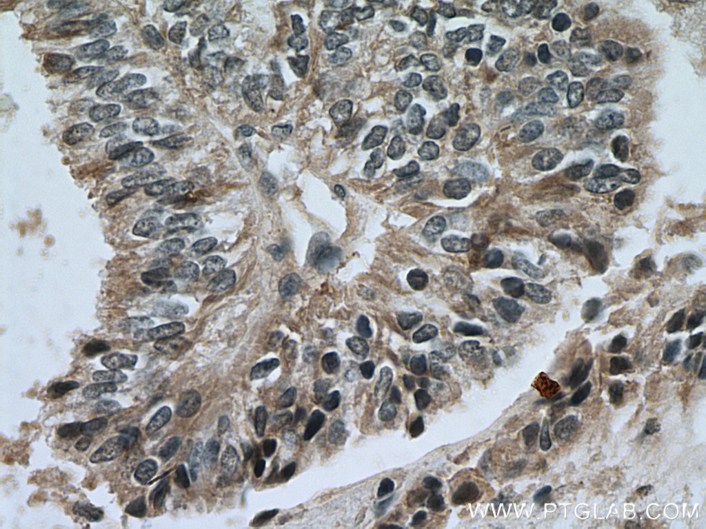 Immunohistochemistry (IHC) staining of human ovary tumor tissue using YTHDC1 Polyclonal antibody (14392-1-AP)