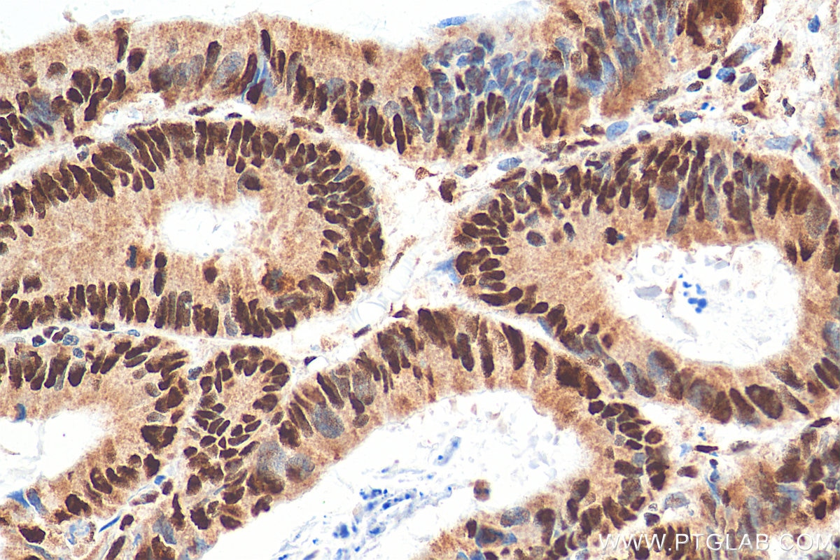 Immunohistochemistry (IHC) staining of human colon cancer tissue using YTHDC1 Polyclonal antibody (29441-1-AP)