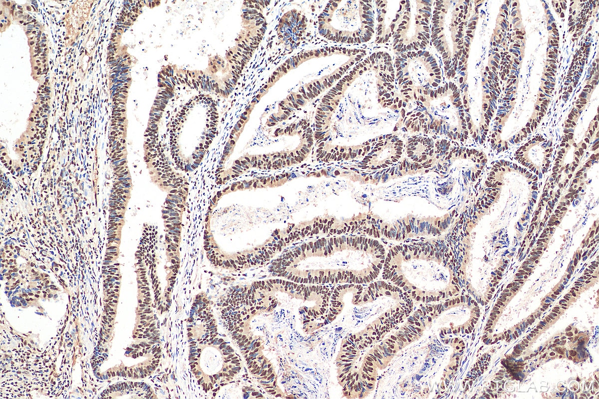 Immunohistochemistry (IHC) staining of human colon cancer tissue using YTHDC1 Polyclonal antibody (29441-1-AP)