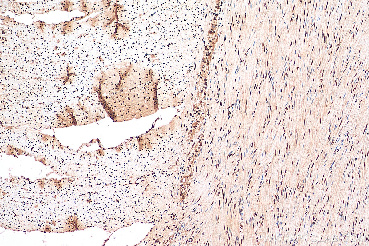 Immunohistochemistry (IHC) staining of human colon cancer tissue using YTHDC1 Polyclonal antibody (29441-1-AP)