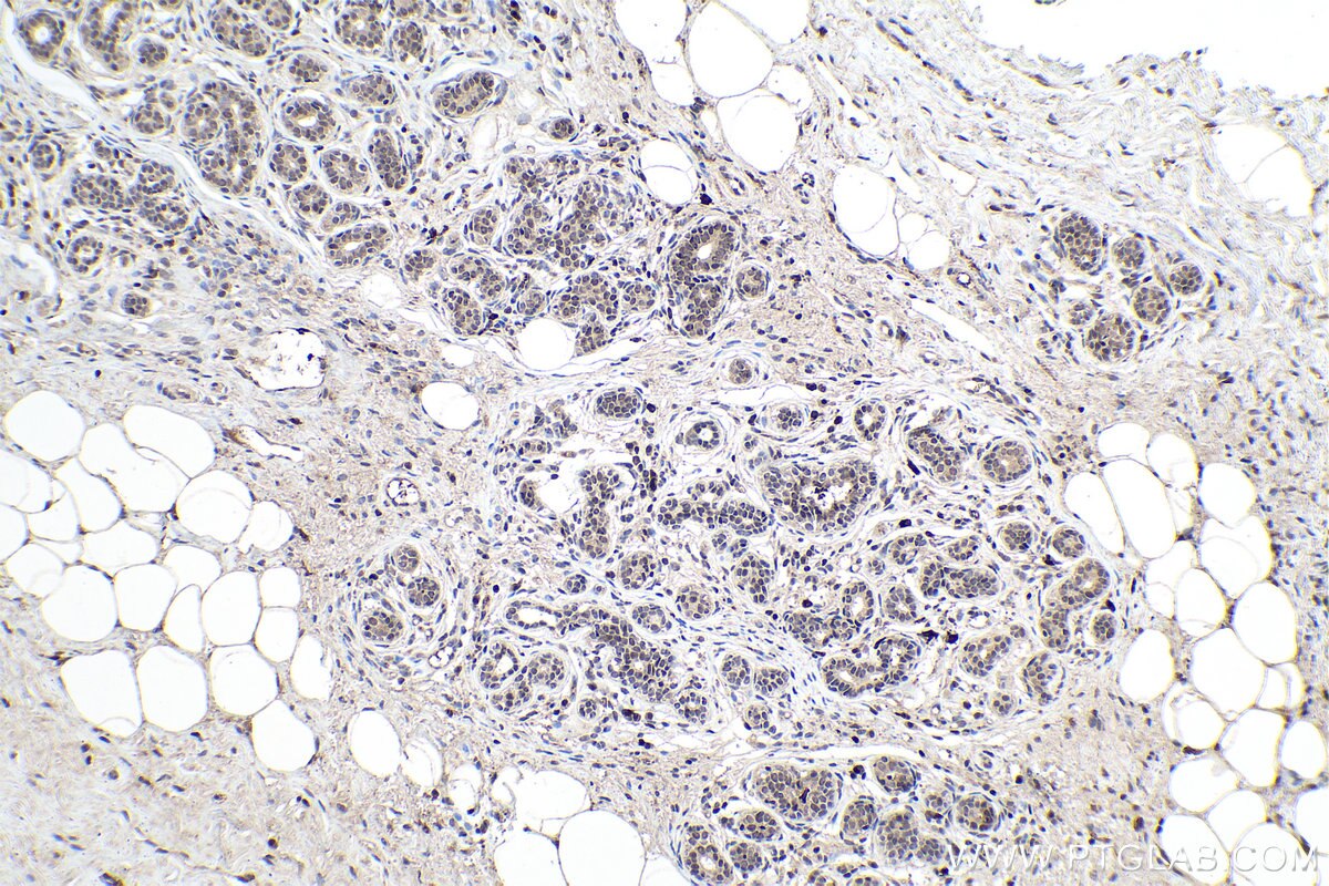 Immunohistochemistry (IHC) staining of human breast cancer tissue using YTHDC1 Monoclonal antibody (67911-1-Ig)