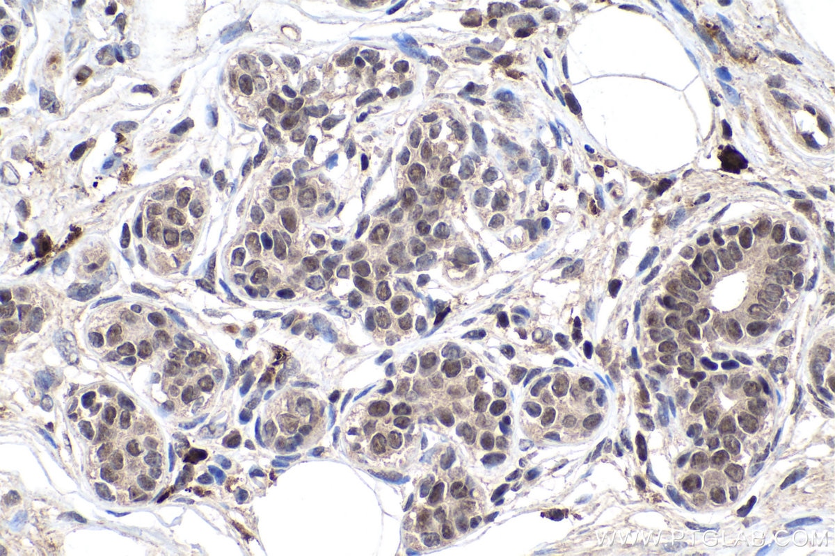 Immunohistochemistry (IHC) staining of human breast cancer tissue using YTHDC1 Monoclonal antibody (67911-1-Ig)