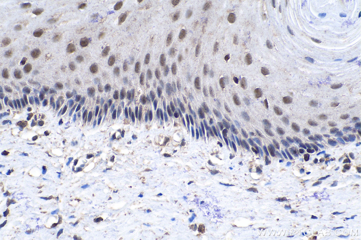 Immunohistochemistry (IHC) staining of human cervical cancer tissue using YTHDC1 Monoclonal antibody (67911-1-Ig)
