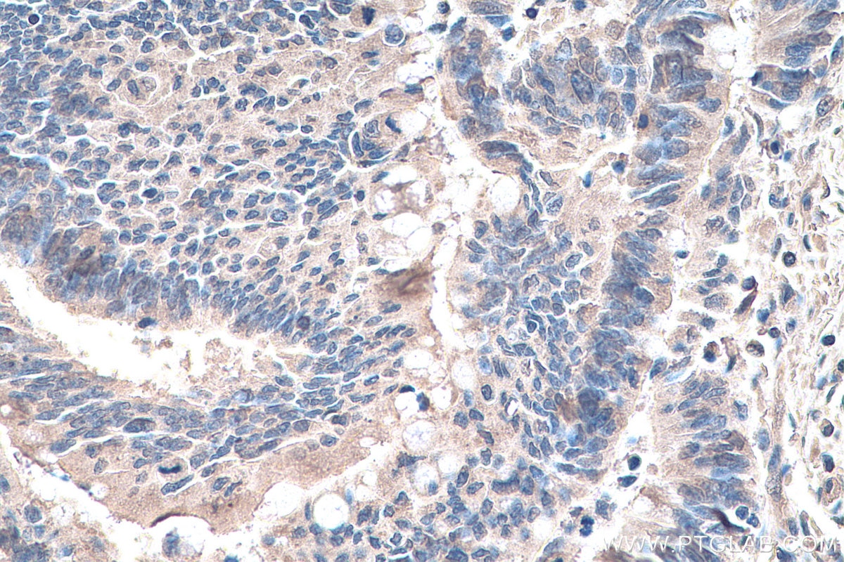 Immunohistochemistry (IHC) staining of human colon cancer tissue using YTHDF1 Monoclonal antibody (66745-1-Ig)