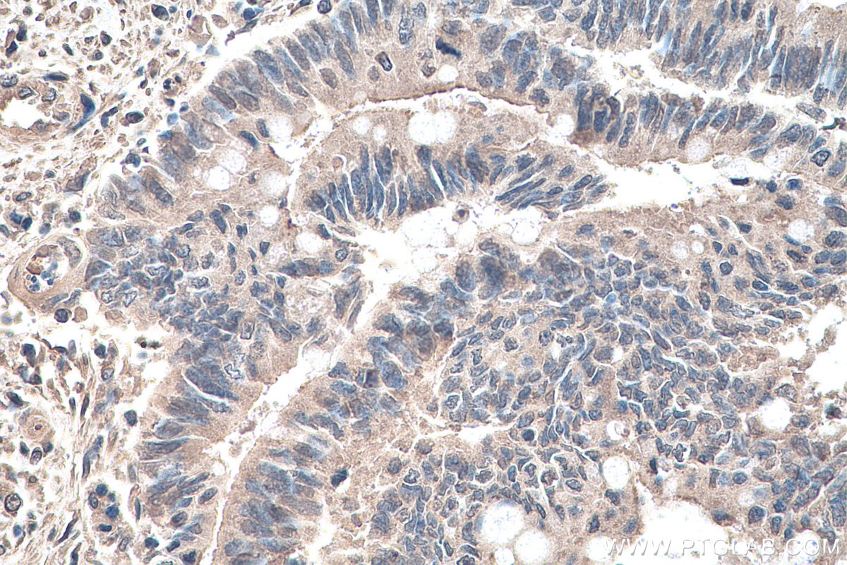 Immunohistochemistry (IHC) staining of human colon cancer tissue using YTHDF1 Monoclonal antibody (66745-1-Ig)