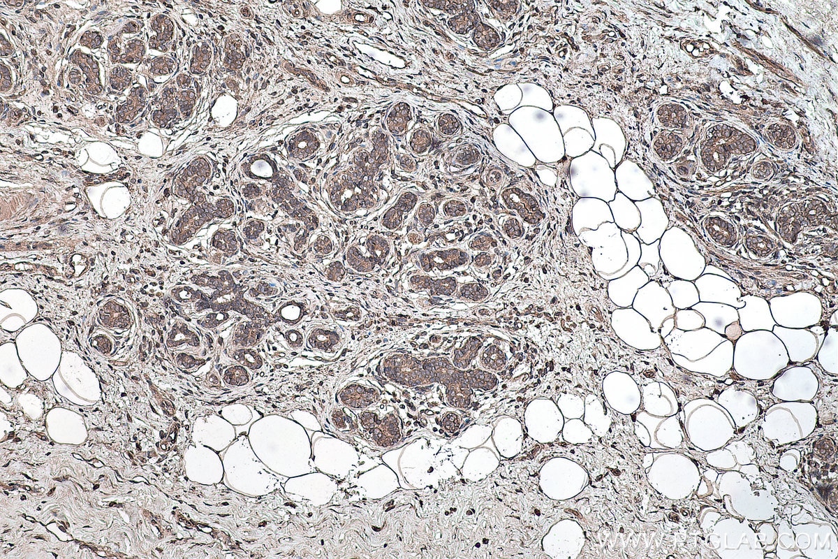 Immunohistochemistry (IHC) staining of human breast cancer tissue using YTHDF1 Monoclonal antibody (66745-1-Ig)