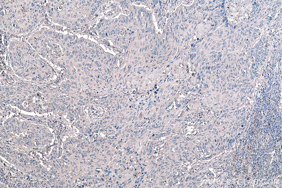 Immunohistochemistry (IHC) staining of human lung cancer tissue using YTHDF1 Monoclonal antibody (66745-1-Ig)