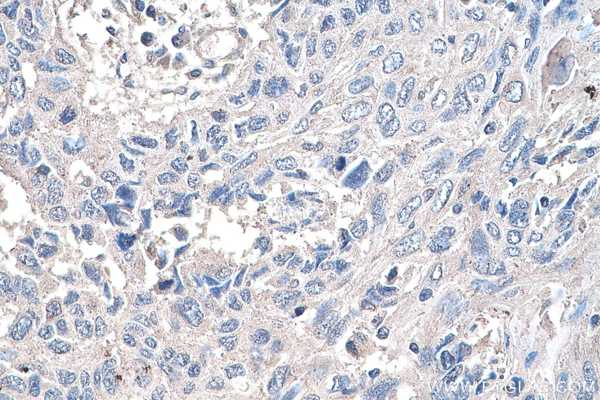 Immunohistochemistry (IHC) staining of human lung cancer tissue using YTHDF1 Monoclonal antibody (66745-1-Ig)