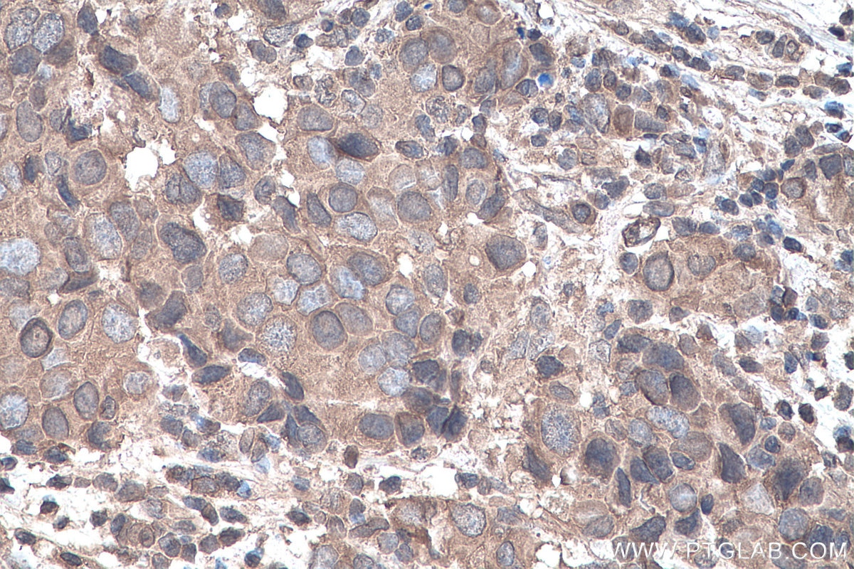 Immunohistochemistry (IHC) staining of human breast cancer tissue using YTHDF1 Monoclonal antibody (66745-1-Ig)