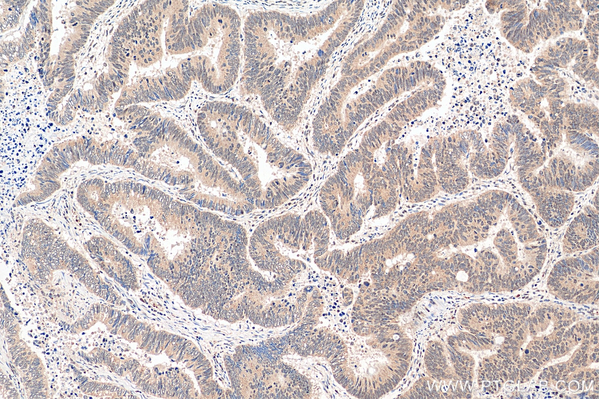 Immunohistochemistry (IHC) staining of human colon cancer tissue using YTHDF3-specific Polyclonal antibody (25537-1-AP)