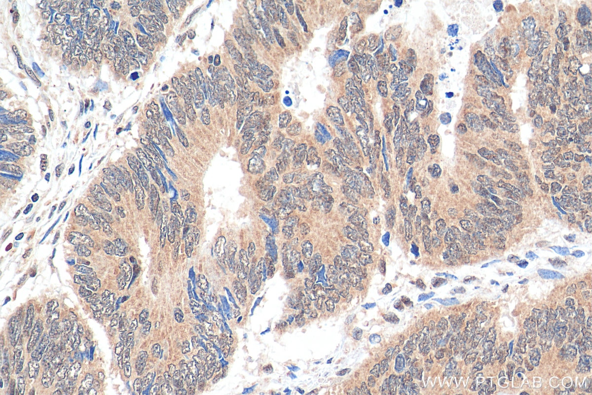 Immunohistochemistry (IHC) staining of human colon cancer tissue using YTHDF3-specific Polyclonal antibody (25537-1-AP)