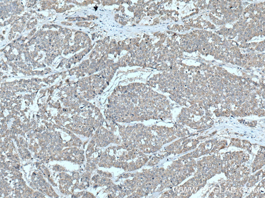 Immunohistochemistry (IHC) staining of human colon cancer tissue using YWHAB Polyclonal antibody (10936-1-AP)