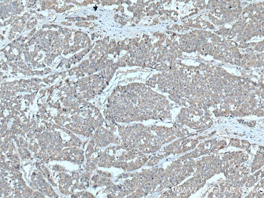 IHC staining of human colon cancer using 10936-1-AP