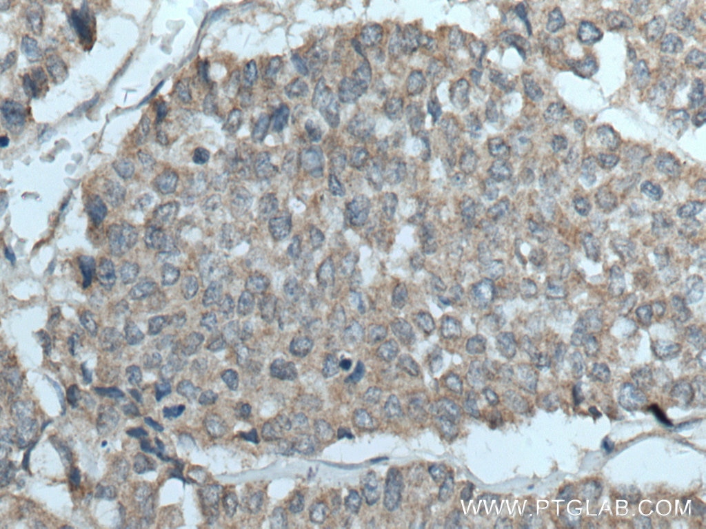 Immunohistochemistry (IHC) staining of human colon cancer tissue using YWHAB Polyclonal antibody (10936-1-AP)