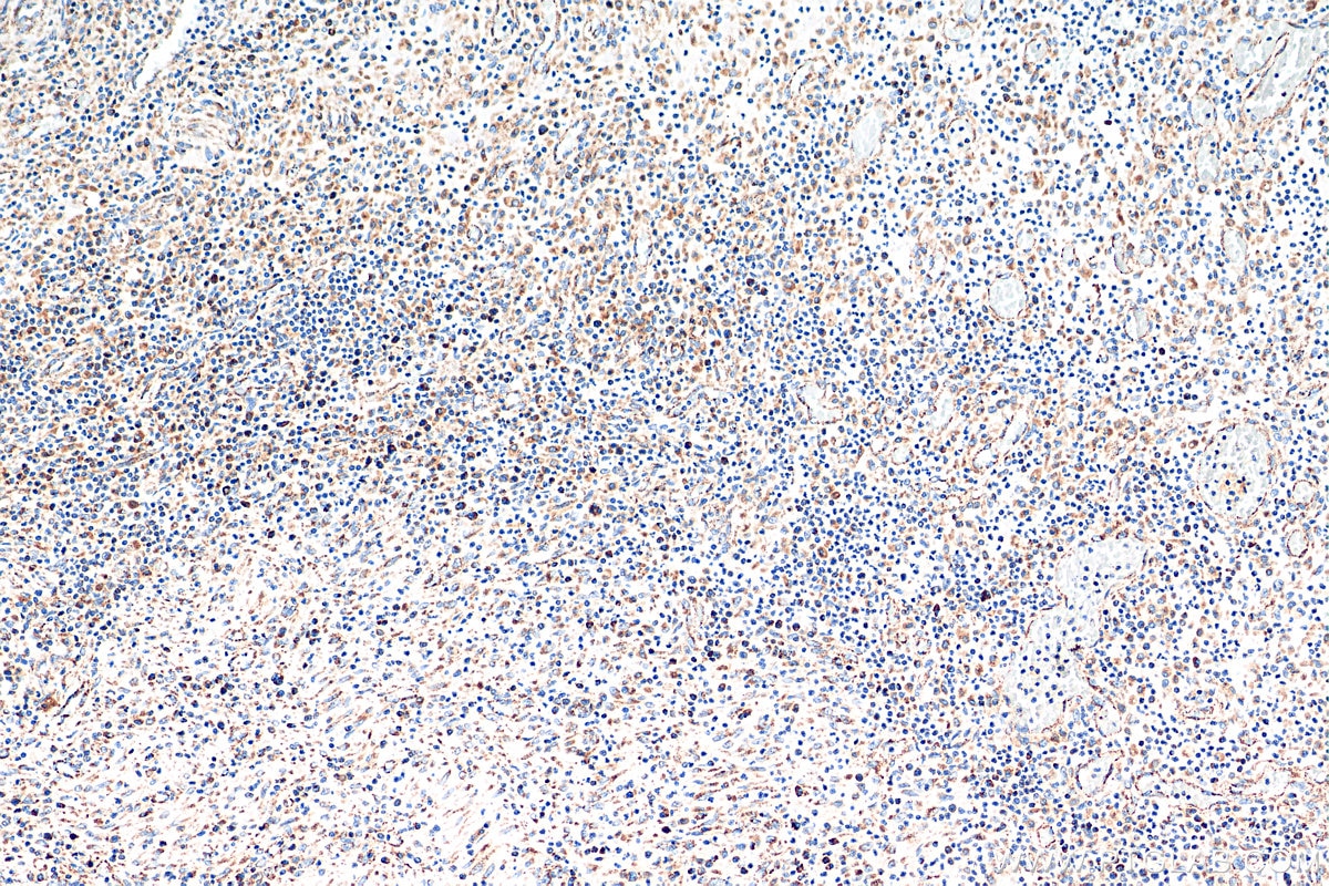 Immunohistochemistry (IHC) staining of human colon cancer tissue using YWHAB Polyclonal antibody (10936-1-AP)