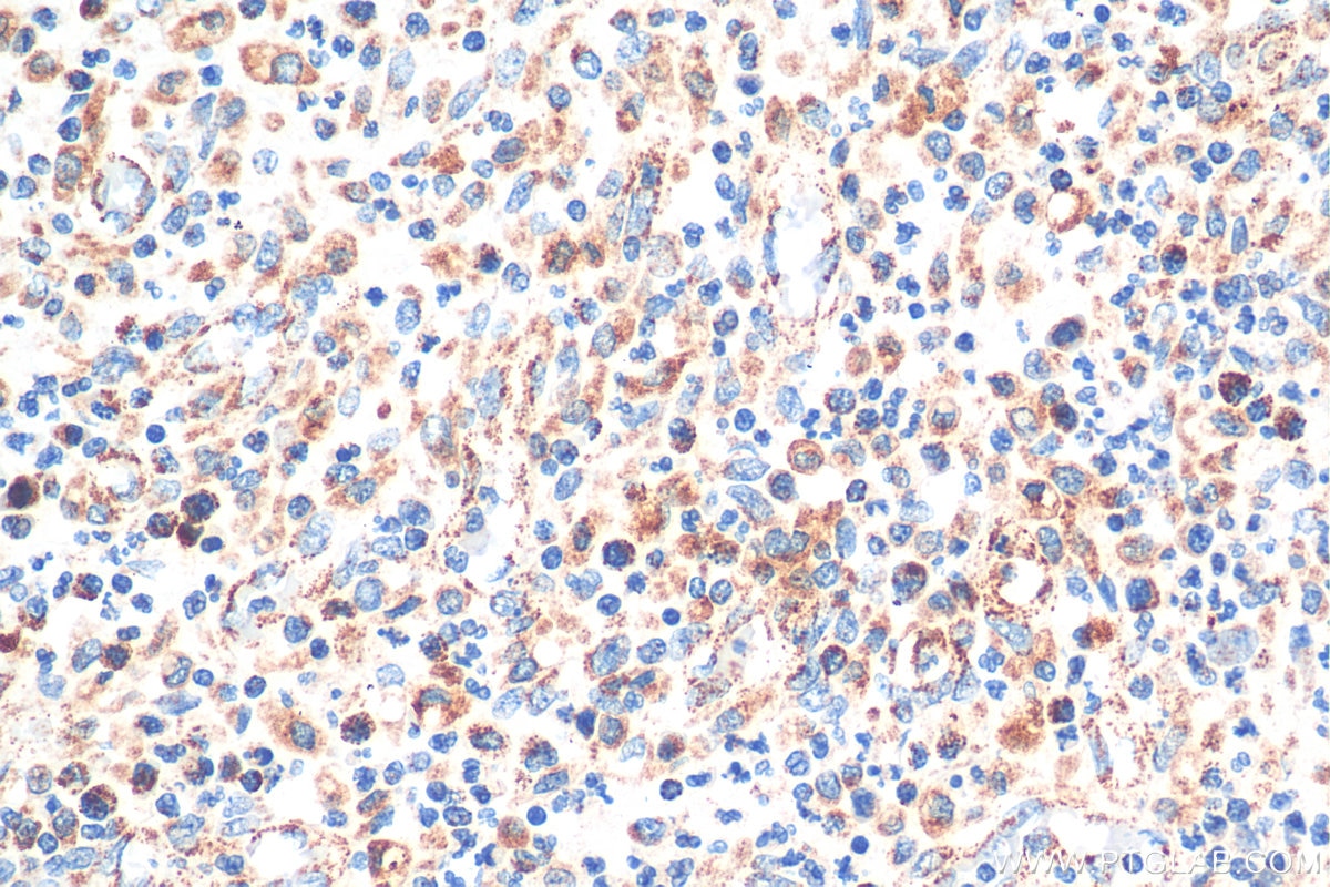 IHC staining of human colon cancer using 10936-1-AP