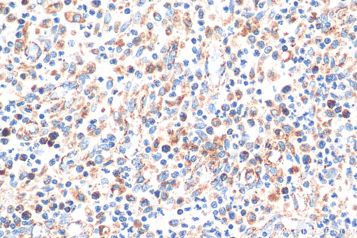 Immunohistochemistry (IHC) staining of human colon cancer tissue using YWHAB Polyclonal antibody (10936-1-AP)