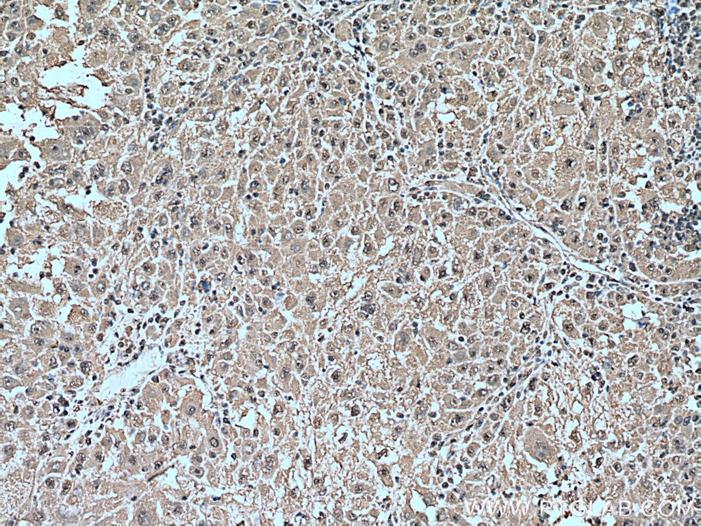 Immunohistochemistry (IHC) staining of human liver cancer tissue using YWHAZ Monoclonal antibody (67698-1-Ig)