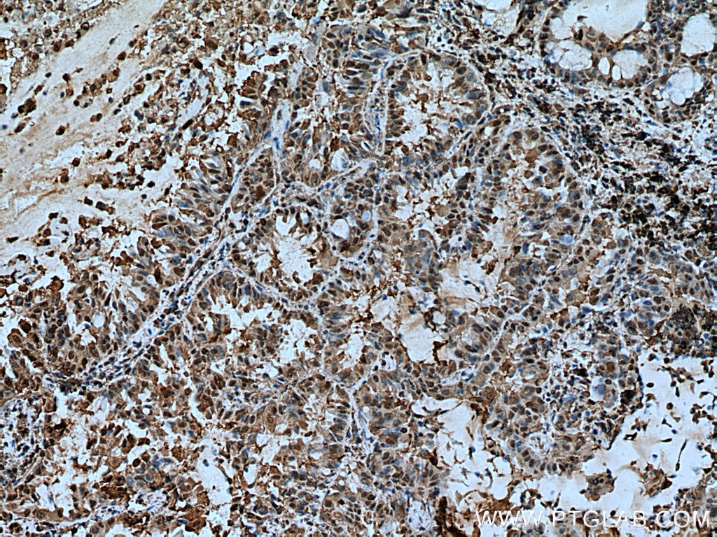 Immunohistochemistry (IHC) staining of human lung cancer tissue using YWHAZ Monoclonal antibody (67698-1-Ig)