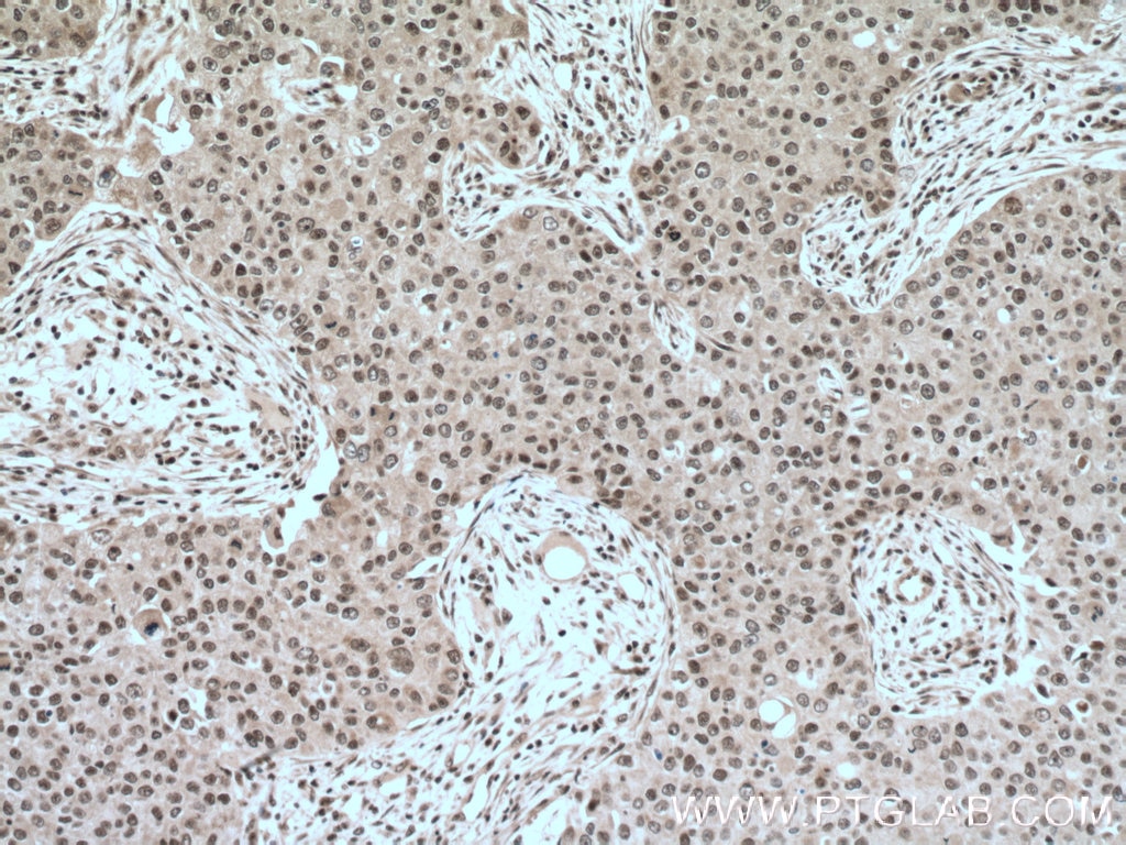 Immunohistochemistry (IHC) staining of human breast cancer tissue using YY1 Polyclonal antibody (22156-1-AP)
