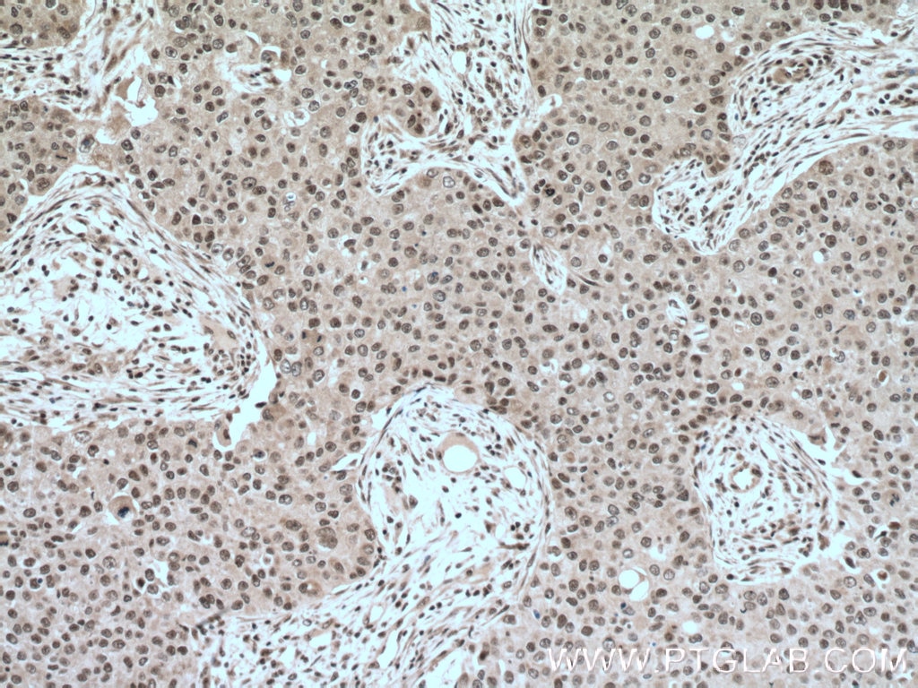 IHC staining of human breast cancer using 22156-1-AP