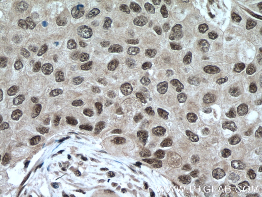 Immunohistochemistry (IHC) staining of human breast cancer tissue using YY1 Polyclonal antibody (22156-1-AP)