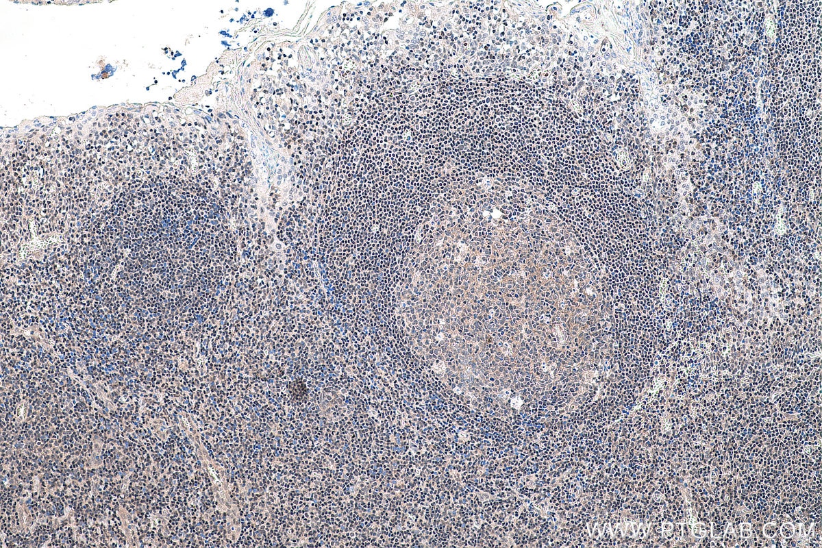 Immunohistochemistry (IHC) staining of human tonsillitis tissue using YY1 Monoclonal antibody (66281-1-Ig)