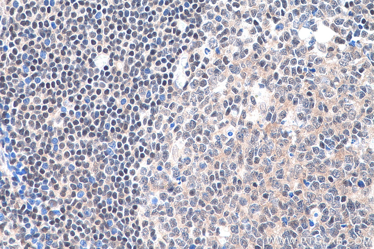 Immunohistochemistry (IHC) staining of human tonsillitis tissue using YY1 Monoclonal antibody (66281-1-Ig)