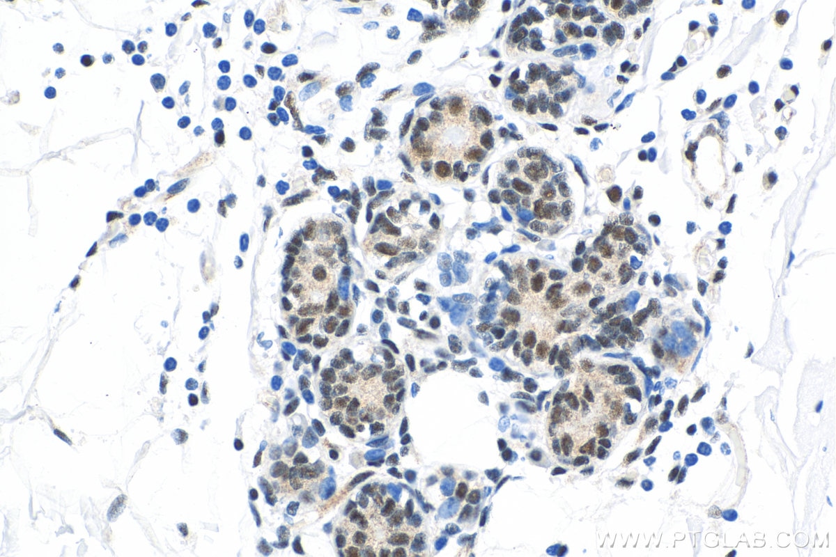 Immunohistochemistry (IHC) staining of human breast cancer tissue using YY1 Monoclonal antibody (66281-1-Ig)