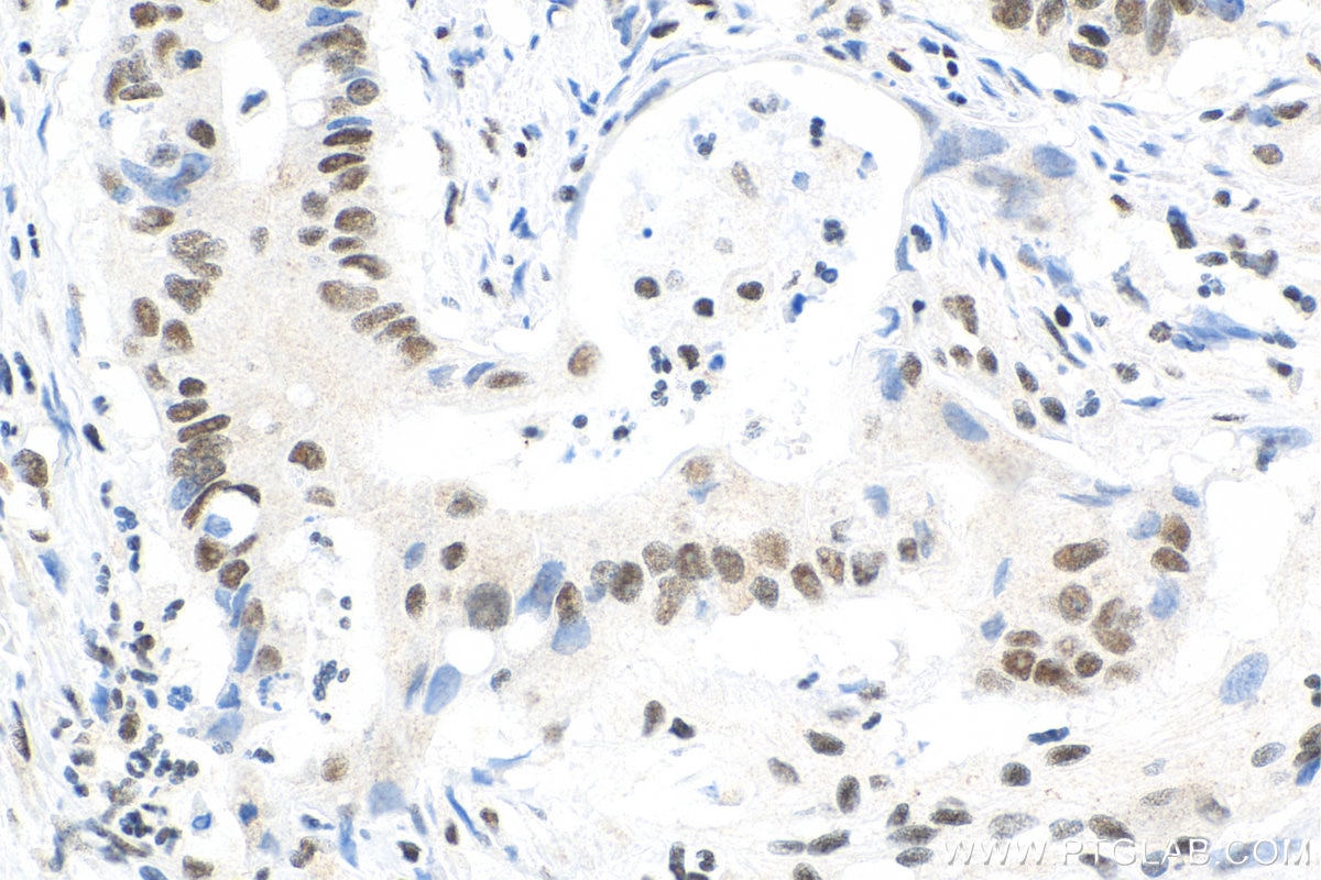 Immunohistochemistry (IHC) staining of human colon cancer tissue using YY1 Monoclonal antibody (66281-1-Ig)