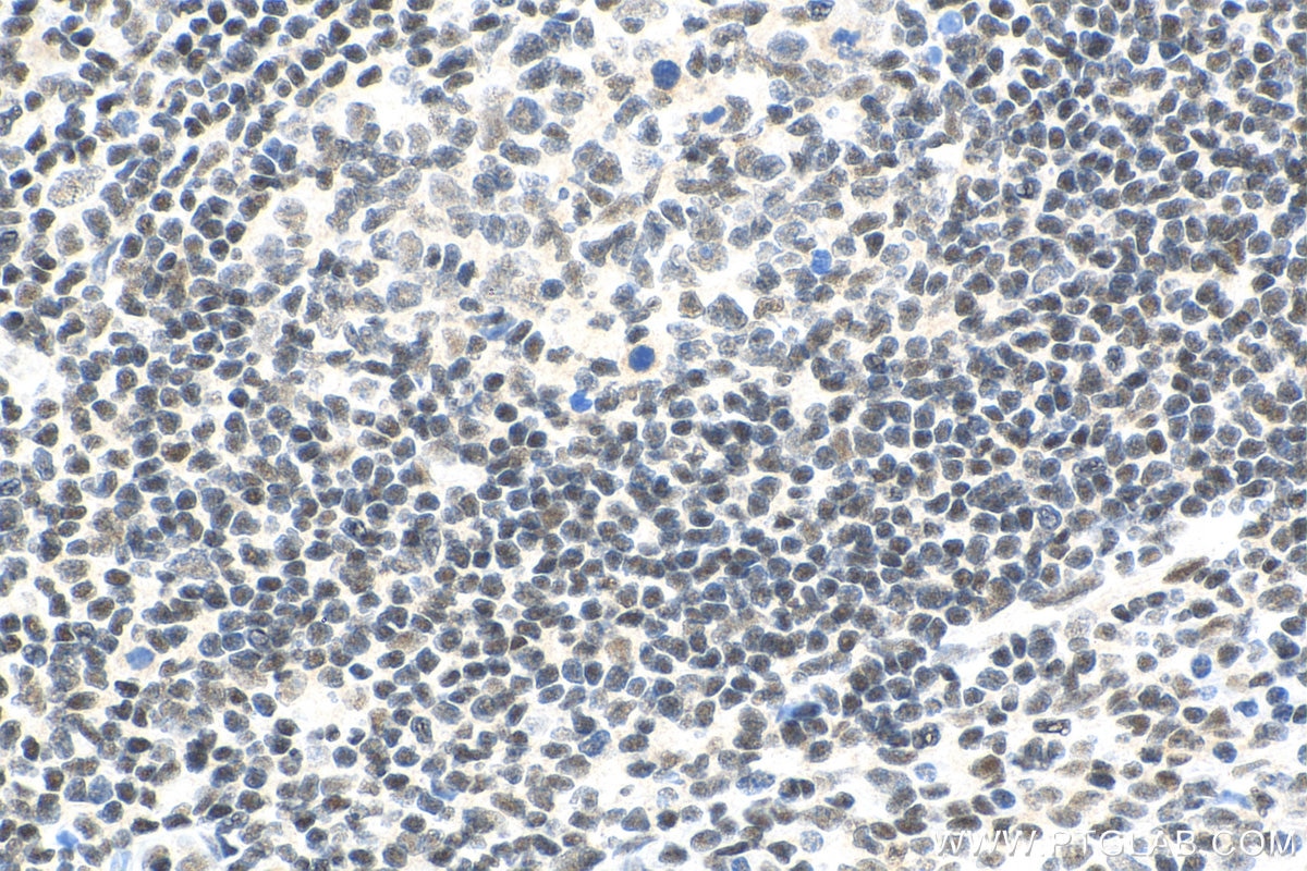 IHC staining of human tonsillitis using 66281-1-Ig