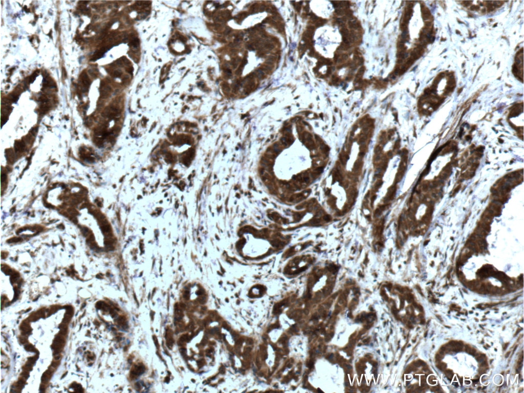 Immunohistochemistry (IHC) staining of human breast cancer tissue using YY1 Monoclonal antibody (66281-1-Ig)