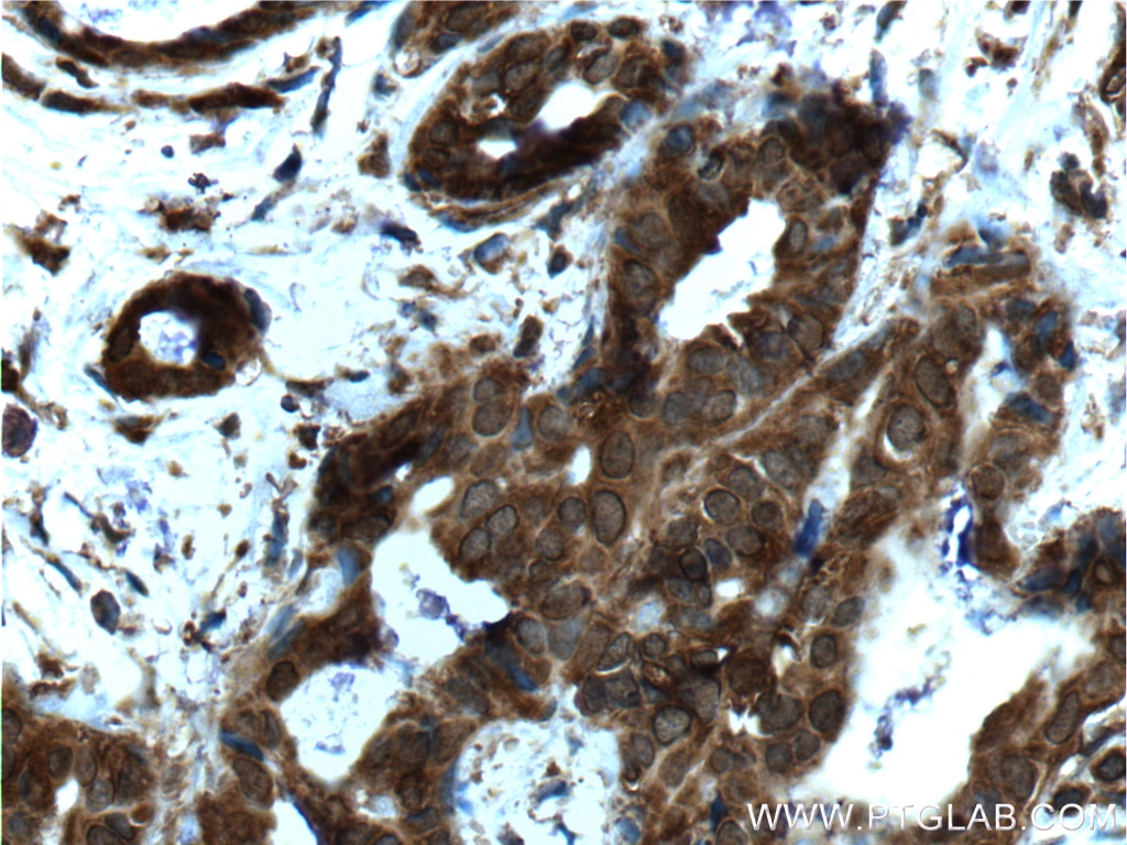 Immunohistochemistry (IHC) staining of human breast cancer tissue using YY1 Monoclonal antibody (66281-1-Ig)